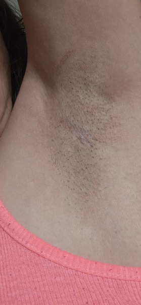 Itchy armpits - perimenopause or fungal infection?