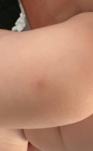 Little bruises in unusual spots - 1yr old.