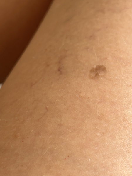 Skin cancer worry