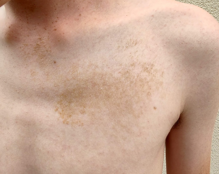 Marks on skin 10 years after scarlet fever