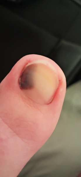 Is this pregnancy related or should I be worried? (Warning - foot related pic!)