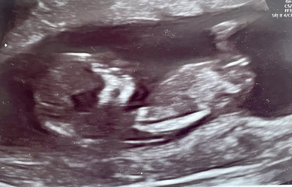 Boy or Girl?