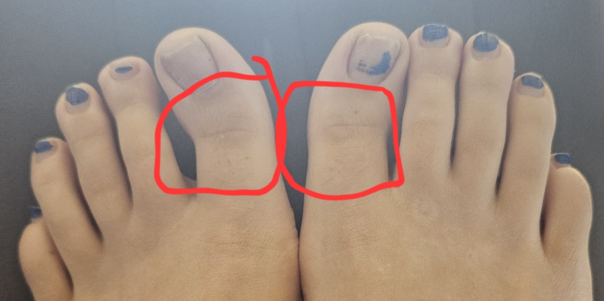 How do I straighten my big toes?!