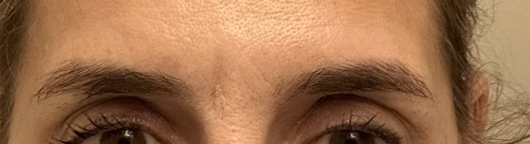 Filler after vascular occlusion