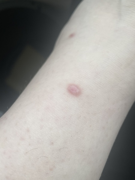 Mole or re lump