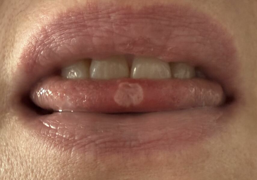 Mouth ulcer help