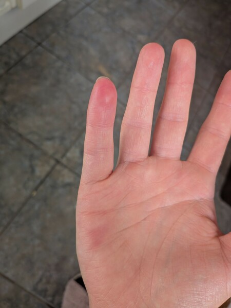 Burnt the tip of my finger