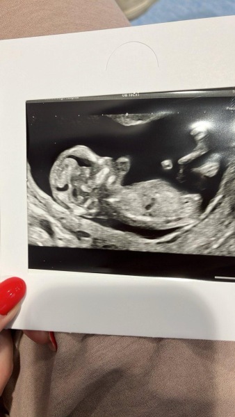Boy or girl guesses