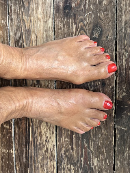 Arthritic big toe