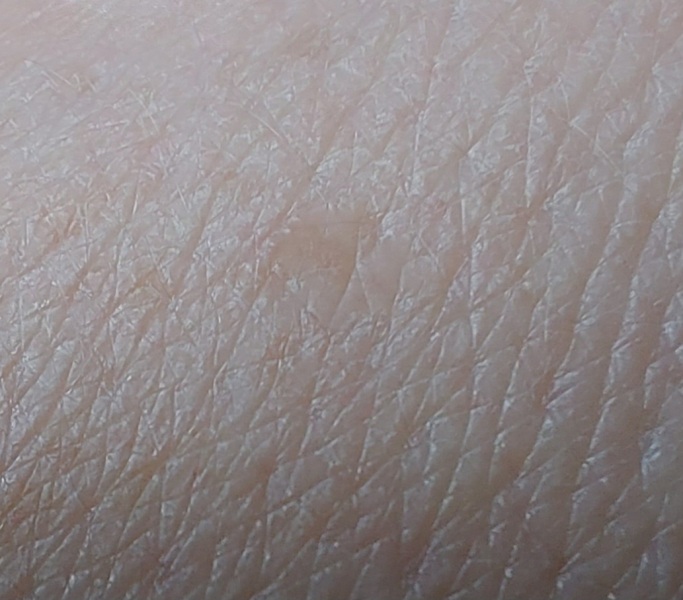 What are these shiny round patches on my hands and forearms?