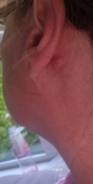 Should I be concerned about this lump behind my ear.