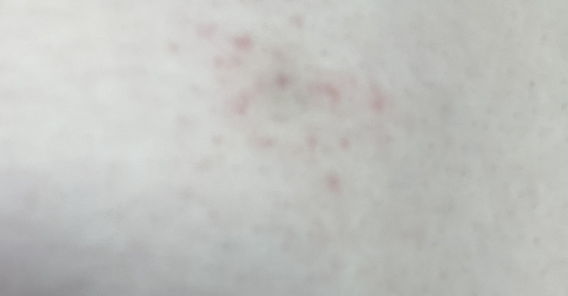 Rash at injection site - image in post