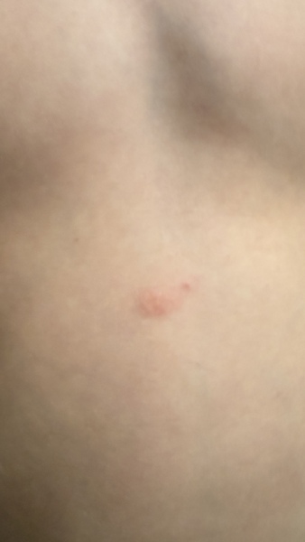 Red lump, bite, start of impetigo or chicken pox?