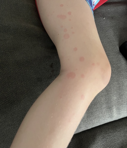 What is this rash on my child???