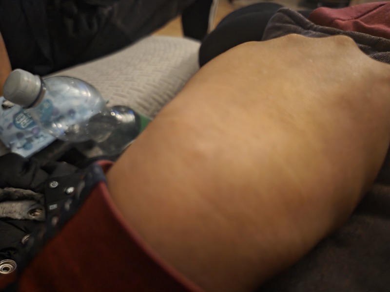 Small lump on back of hand