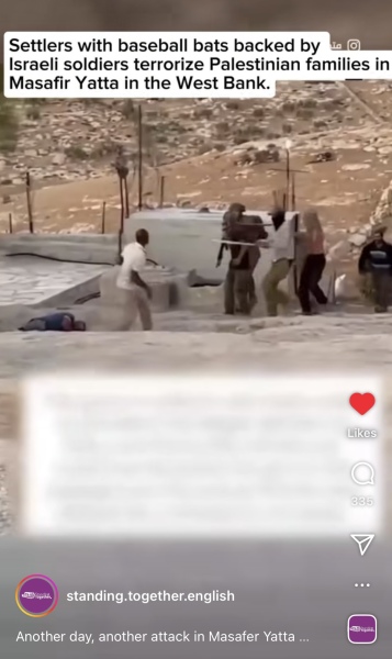 5 year old Jude Shalabi sustained a skull fracture after settlers threw stones at him near Shomrom settlement in the occupied West Bank