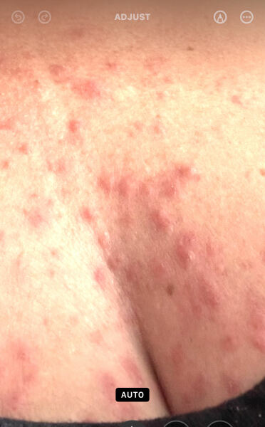 This rash?