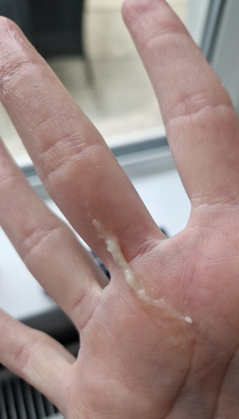 TMI CM Photos 4/5DPO