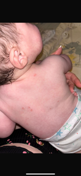 Red spots on baby back?