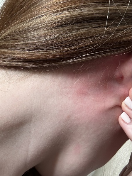 Freaking out… Can anyone tell me what this lump is behind my ear!?