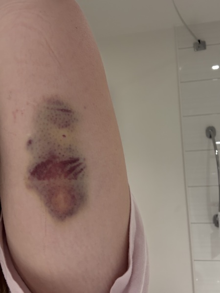 Contraceptive Implant pain and Holiday!