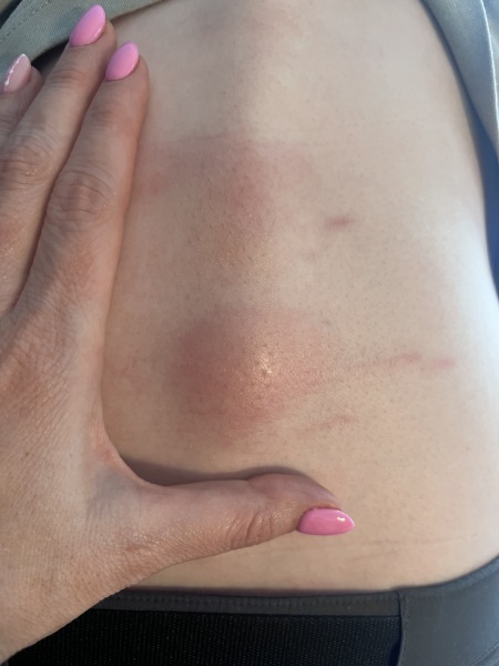 Strange lump on 15 year olds back