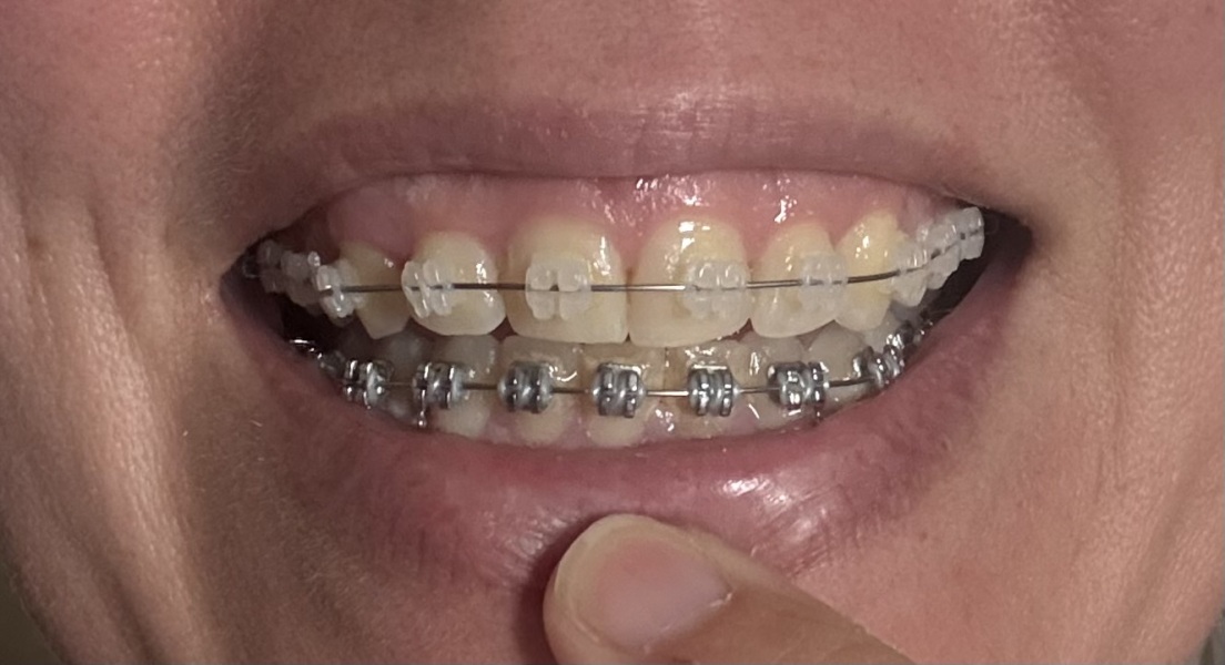 Adult braces - experience