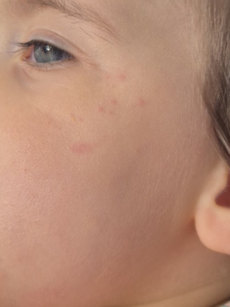 Red blotches when eating