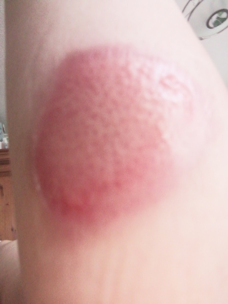 Scald - any A&E nurses?