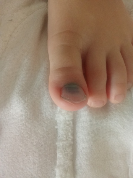 Bruise on nail from injury
