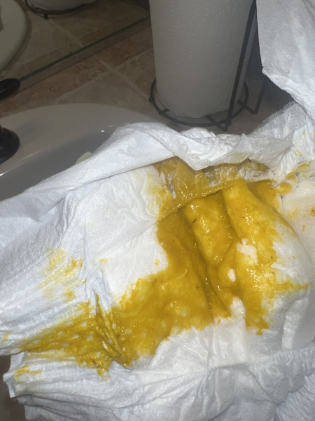 Breast fed Baby Poos WARNING IMAGES ATTACHED ?CMPA