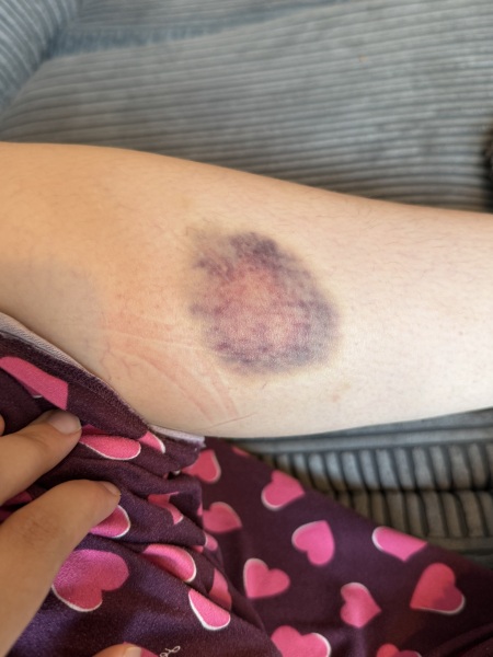 To see the doctor because of these bruises?
