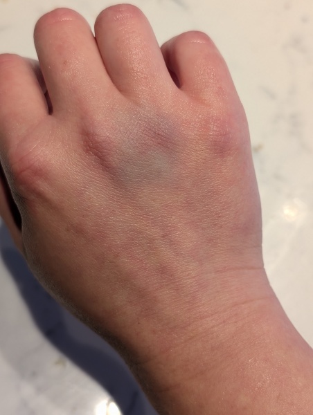 Bruising out of nowhere