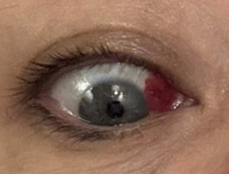 Extremely bloodshot eye - pharmacist?