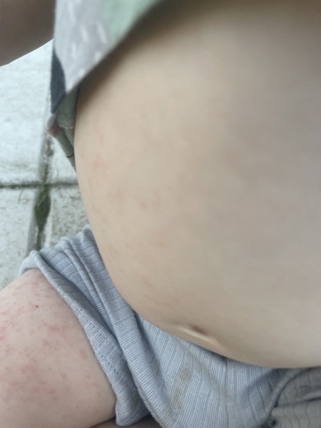 Toddler rash - very worried opinions very much appreciated