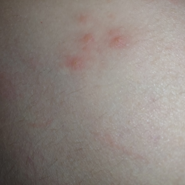 Can you identify this rash?