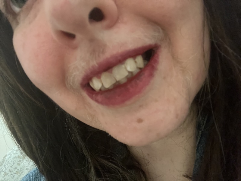 Crown on front tooth causing overbite