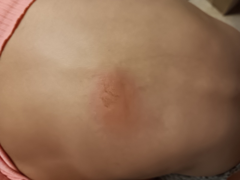 What is this on my daughters back?