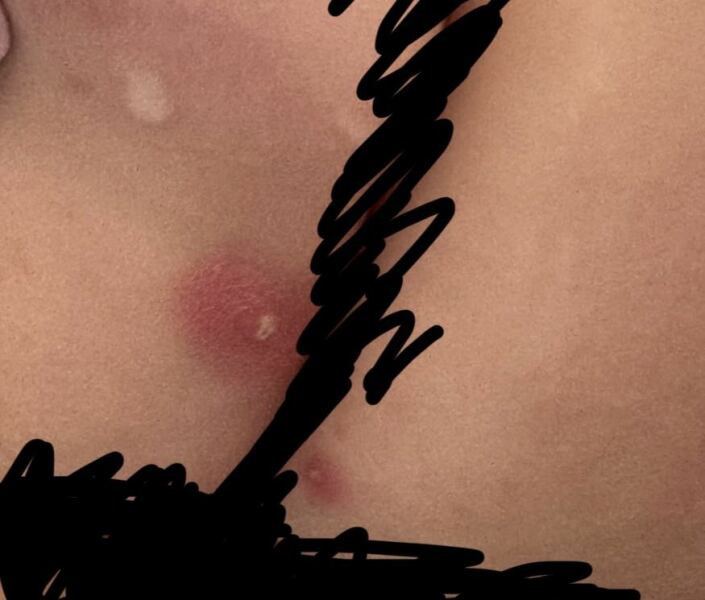 Possible mrsa 3yo? So anxious.. any advice?
