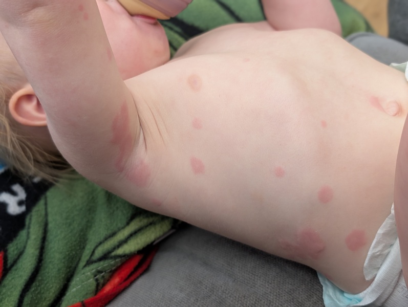 Hives ??? Advice please