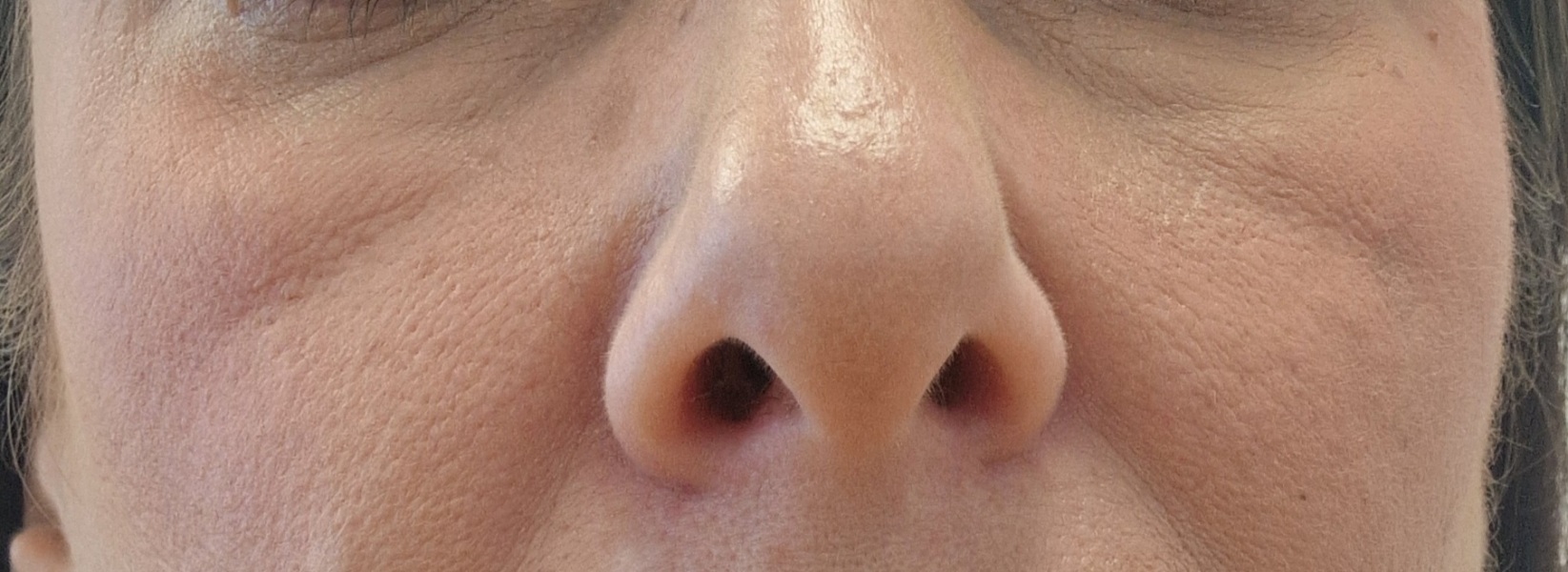 Anyone had filler for mid-cheek lines like this?