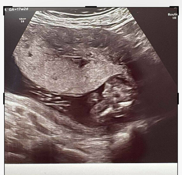 Pregnancy gender scan