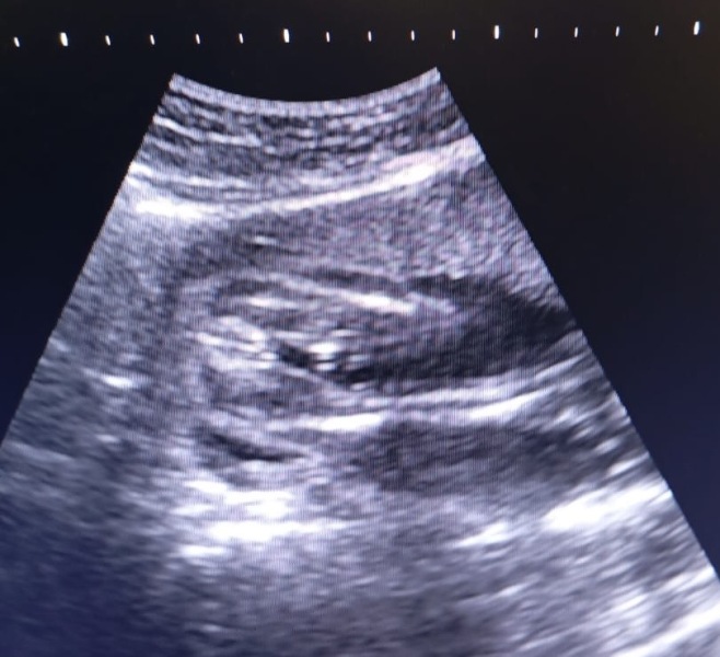 Potty shot 20 weeks! Boy or Girl guesses?