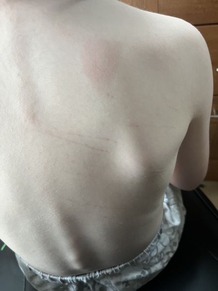 8 year old pale/tired with odd bruising.