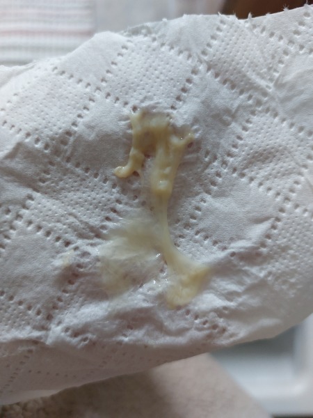 Early pregnancy discharge??