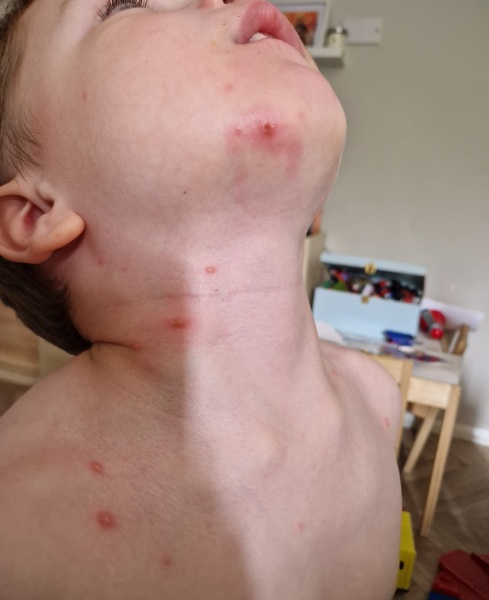 Is this normal chickenpox