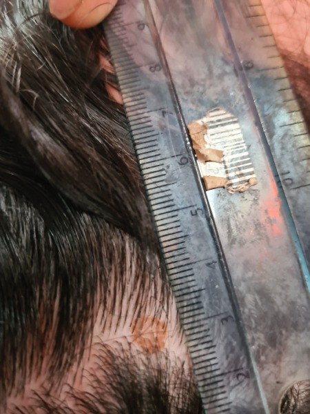 Circle mark on scalp - fungal?