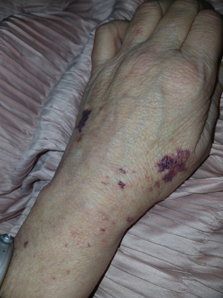 Stroke survivor