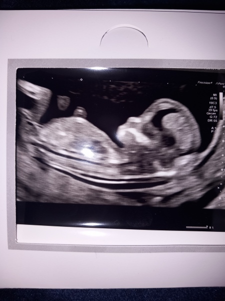Boy or girl? 12 week scan