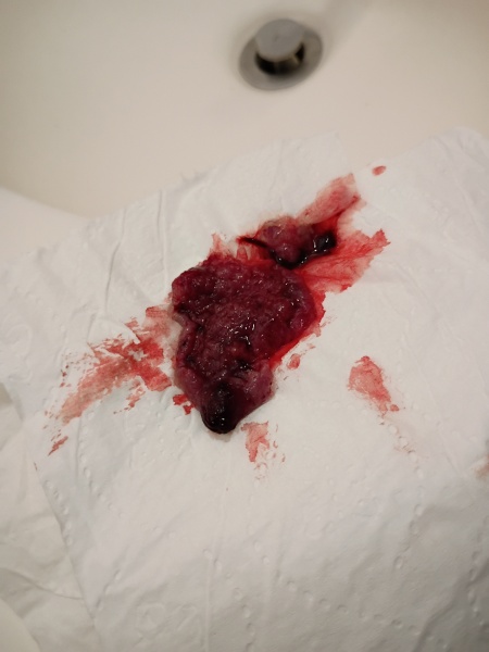 Warning: bloody pictures